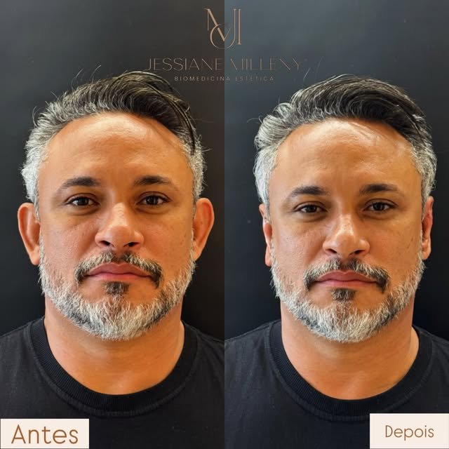 Resultado otomodelação