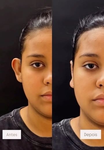 Resultado otomodelação